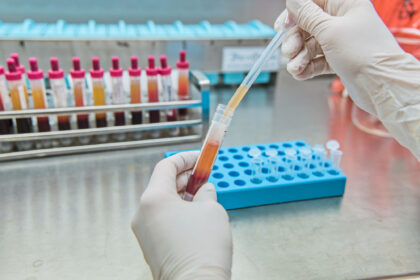 Laboratorní analýza.