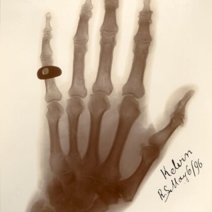 Ruka Lorda Kelvina na rentgenu. Tento snímek pořídil osobně Wilhelm C. Röntgen na schůzi britské Královské společnosti v roce 1896.